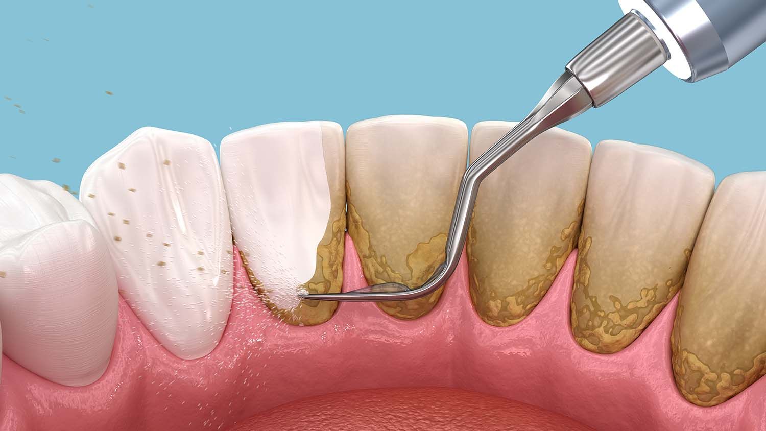 Remove Tartar at Home: Smile Essentials' Guide (2025)