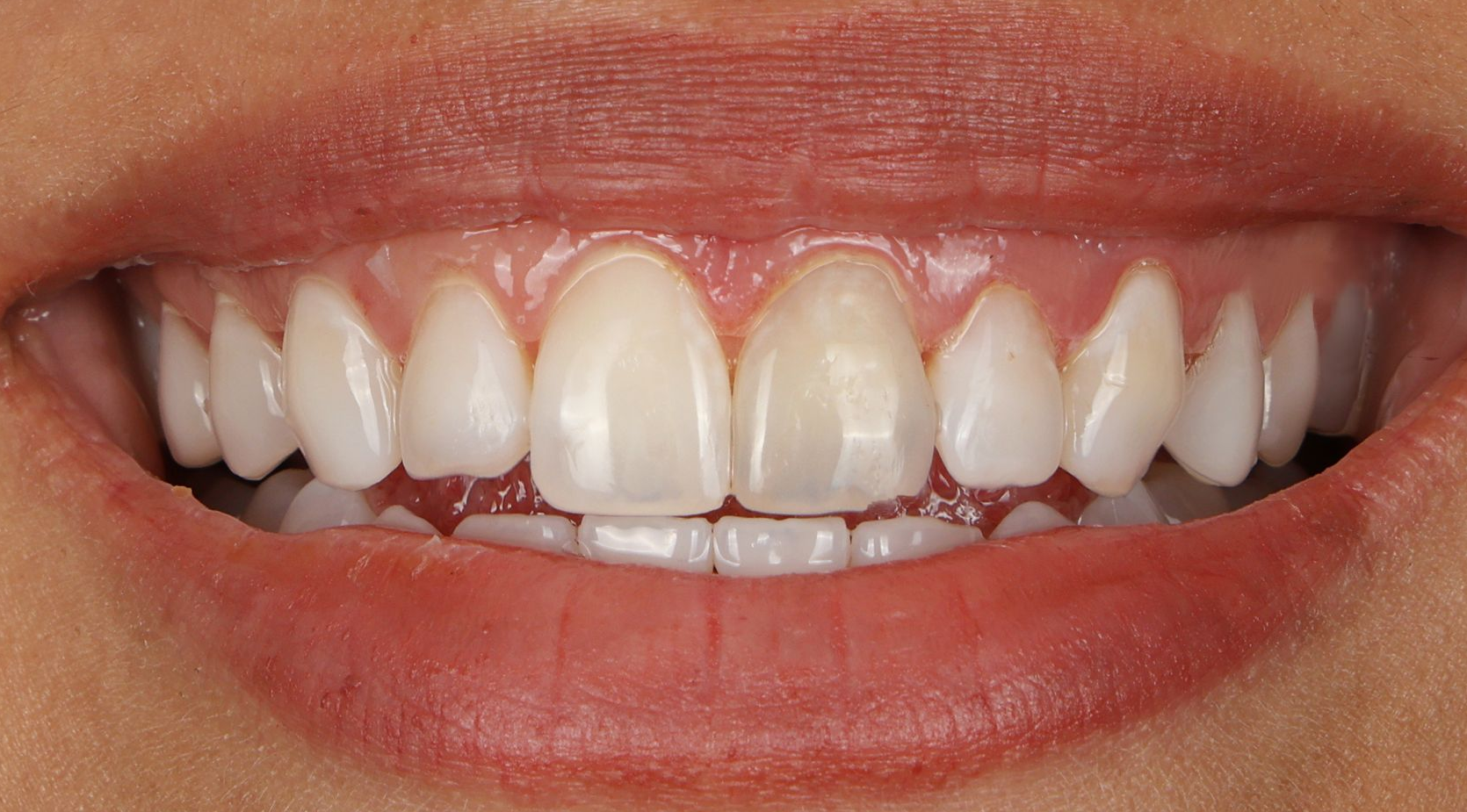 Close-up of a smiling mouth showing white teeth and braces
