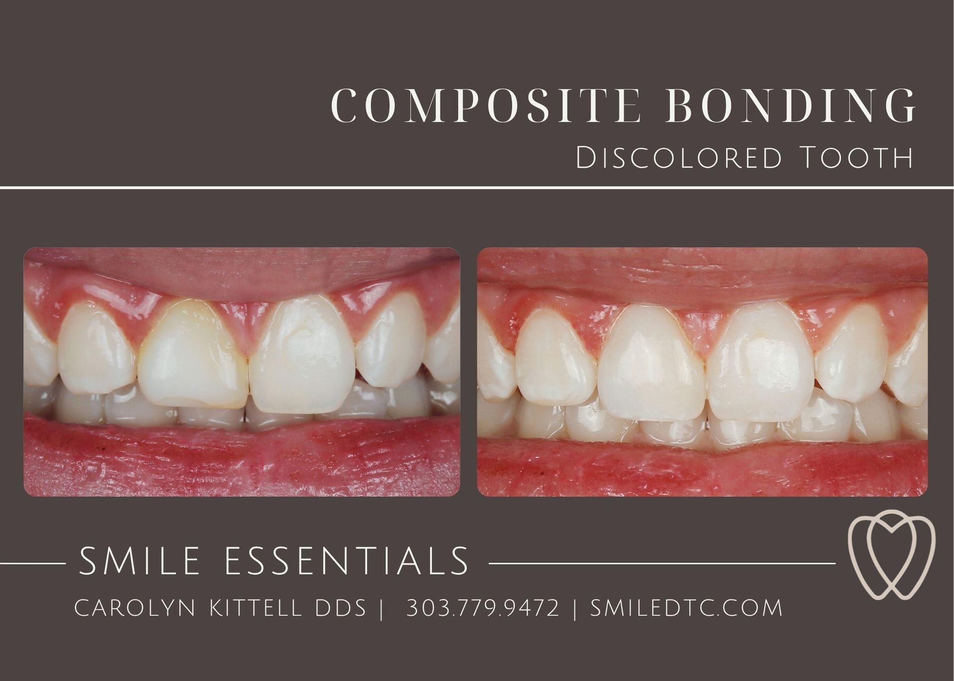 discolored tooth