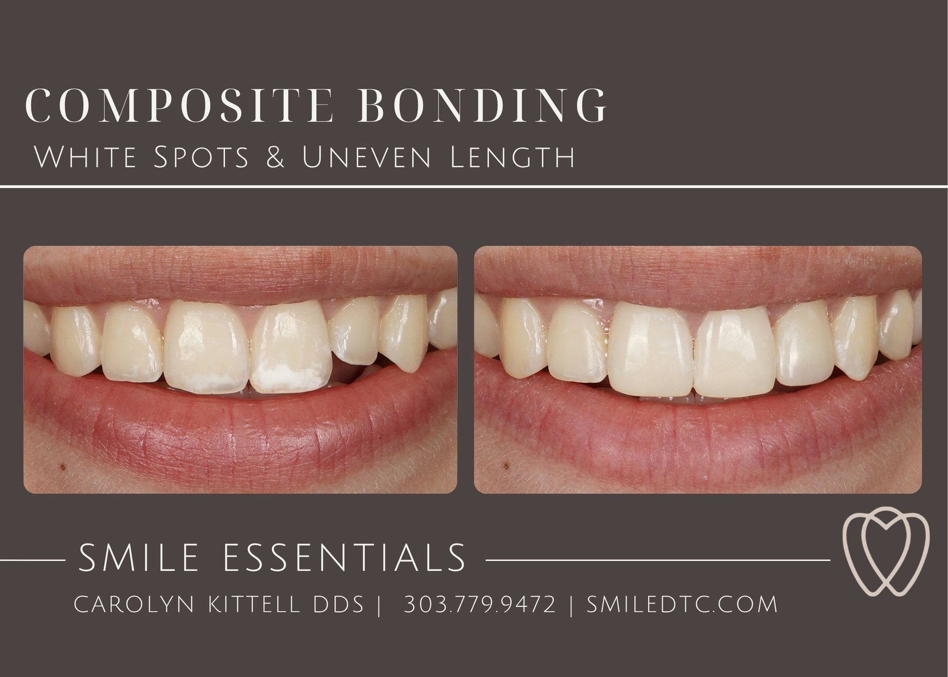 white spot treated with composite bonding