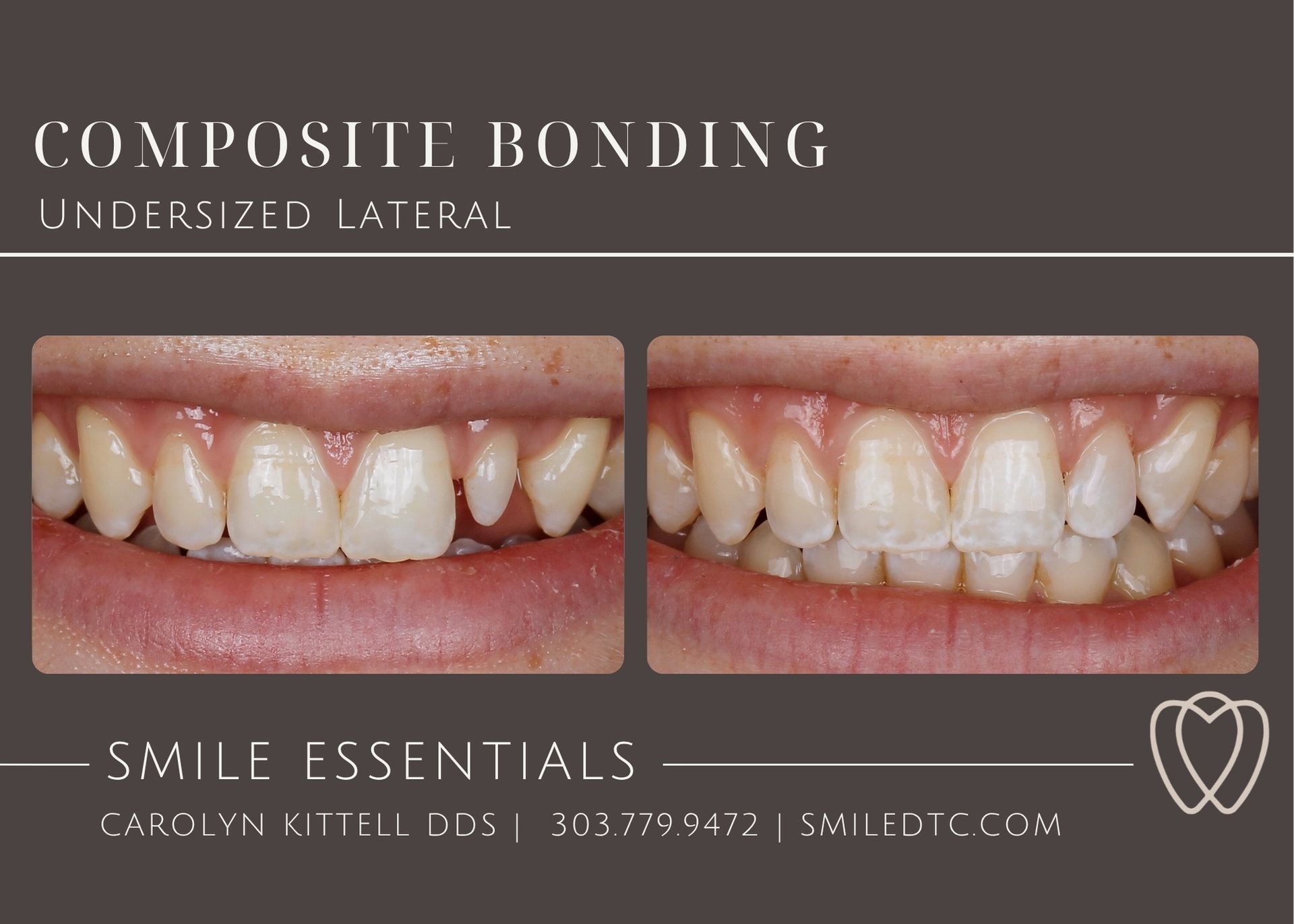 peg lateral