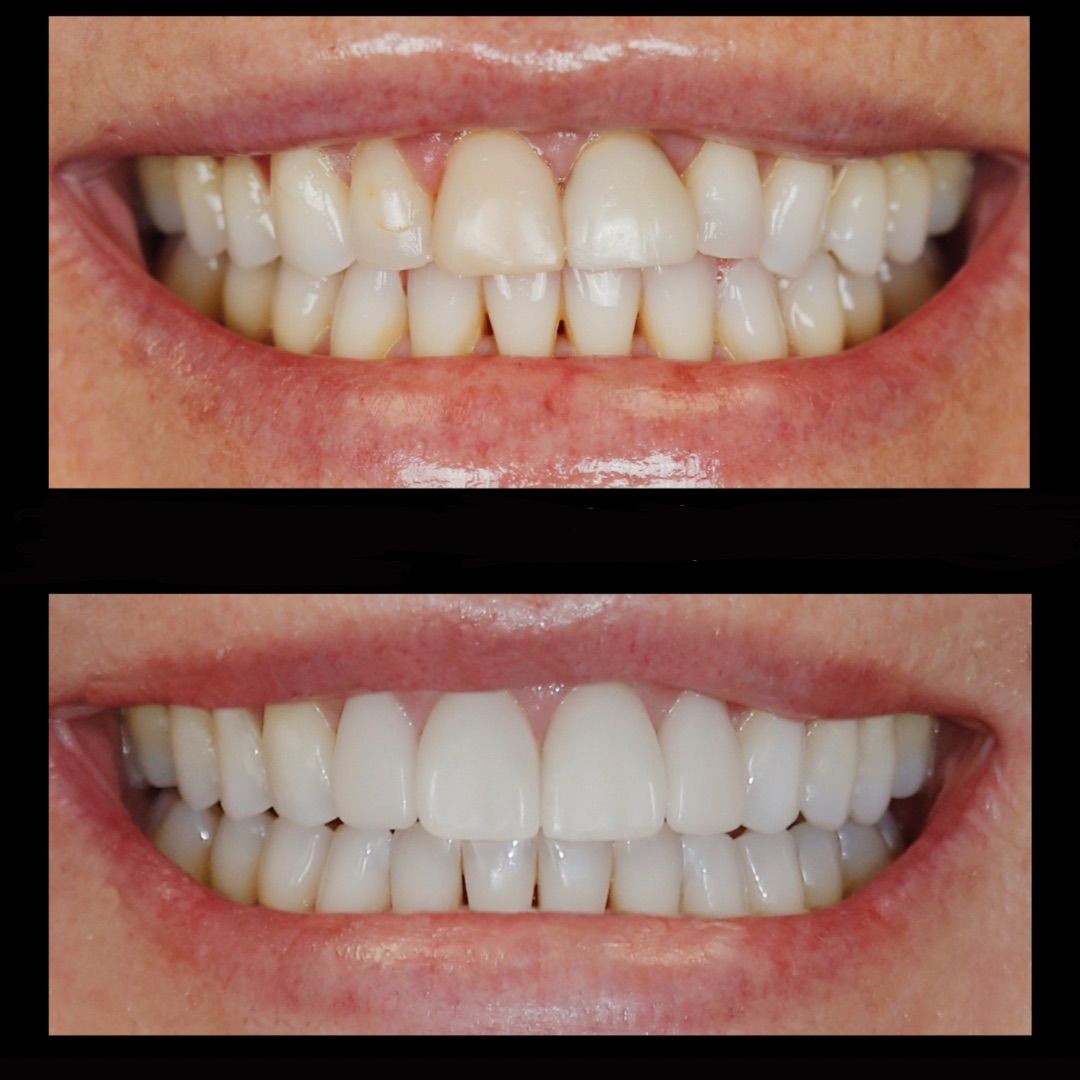 Before-and-after close-up of teeth, showing whiter, straighter teeth in the lower image.