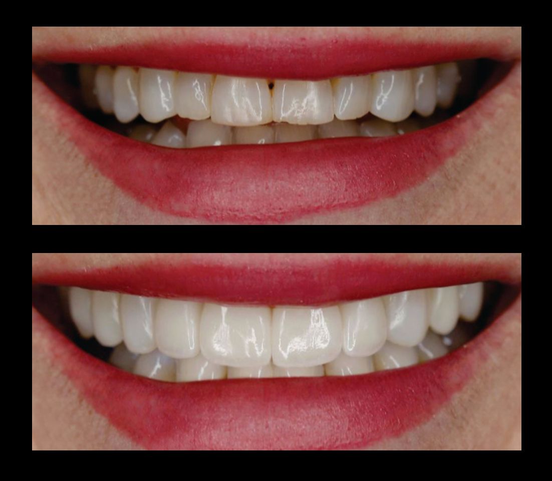 Side-by-side close-ups of a smiling mouth, showing darker and brighter white teeth before and after whitening.