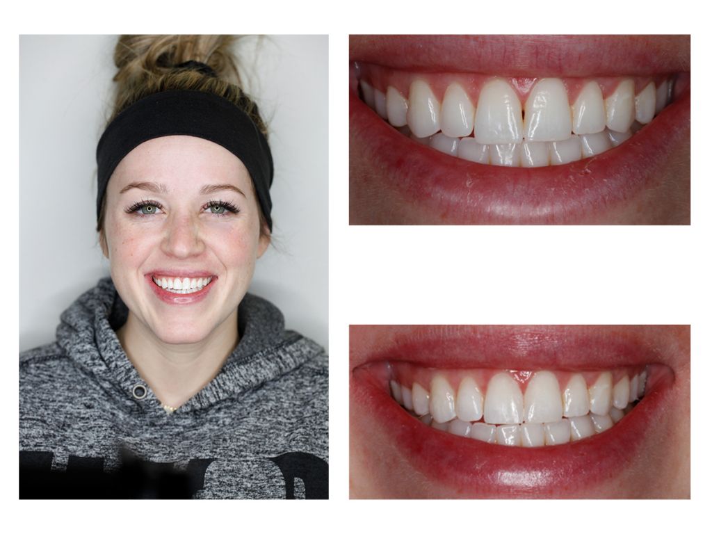 Cosmetic Composite Bonding 30