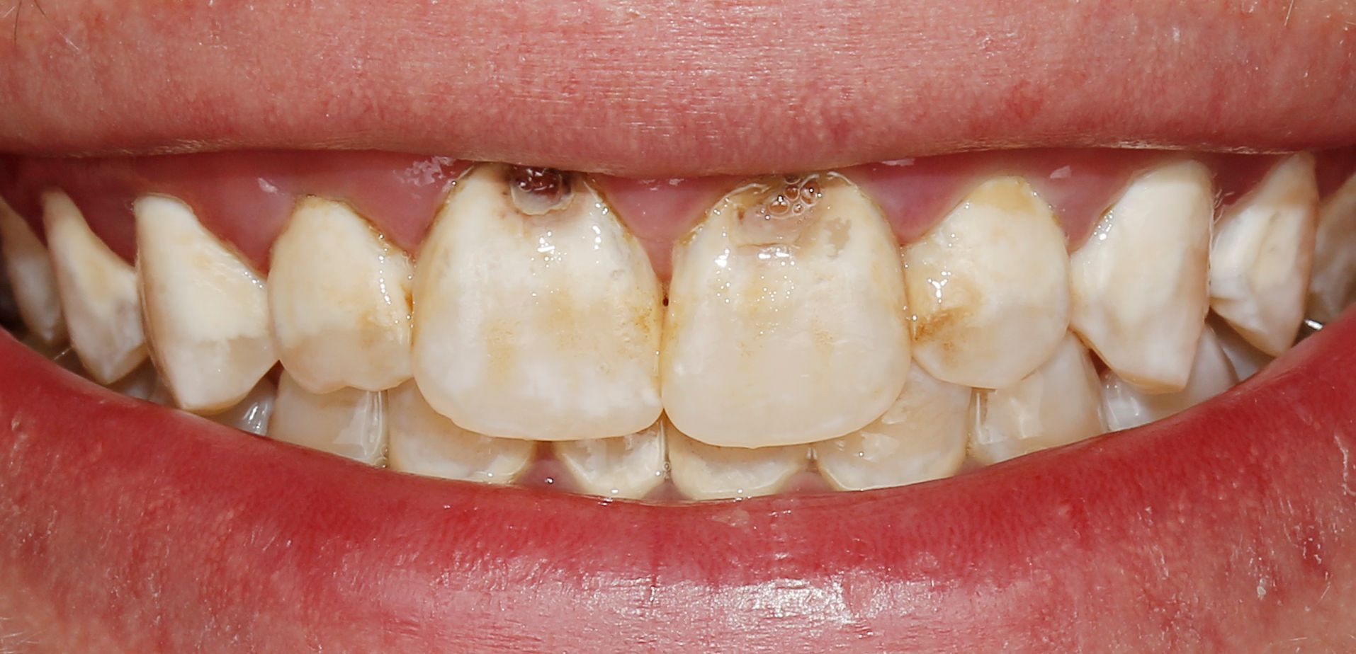Tooth discoloration and cavities from braces