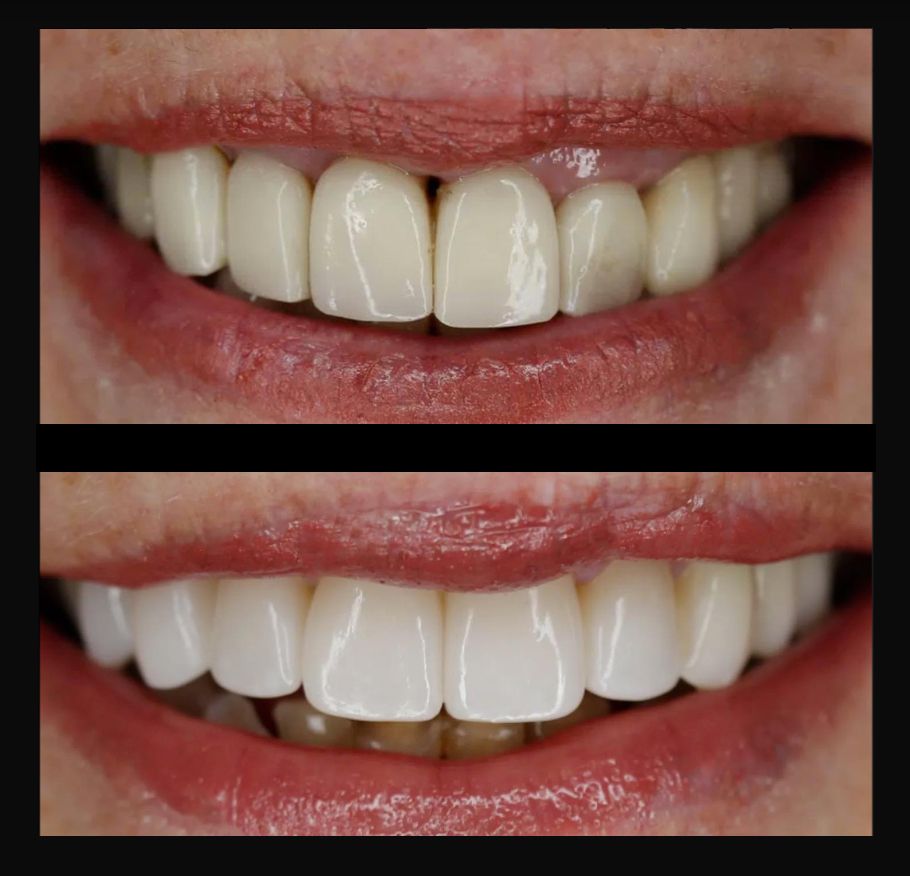 Before-and-after close-up of smiling mouth, showing whiter teeth in the lower image.