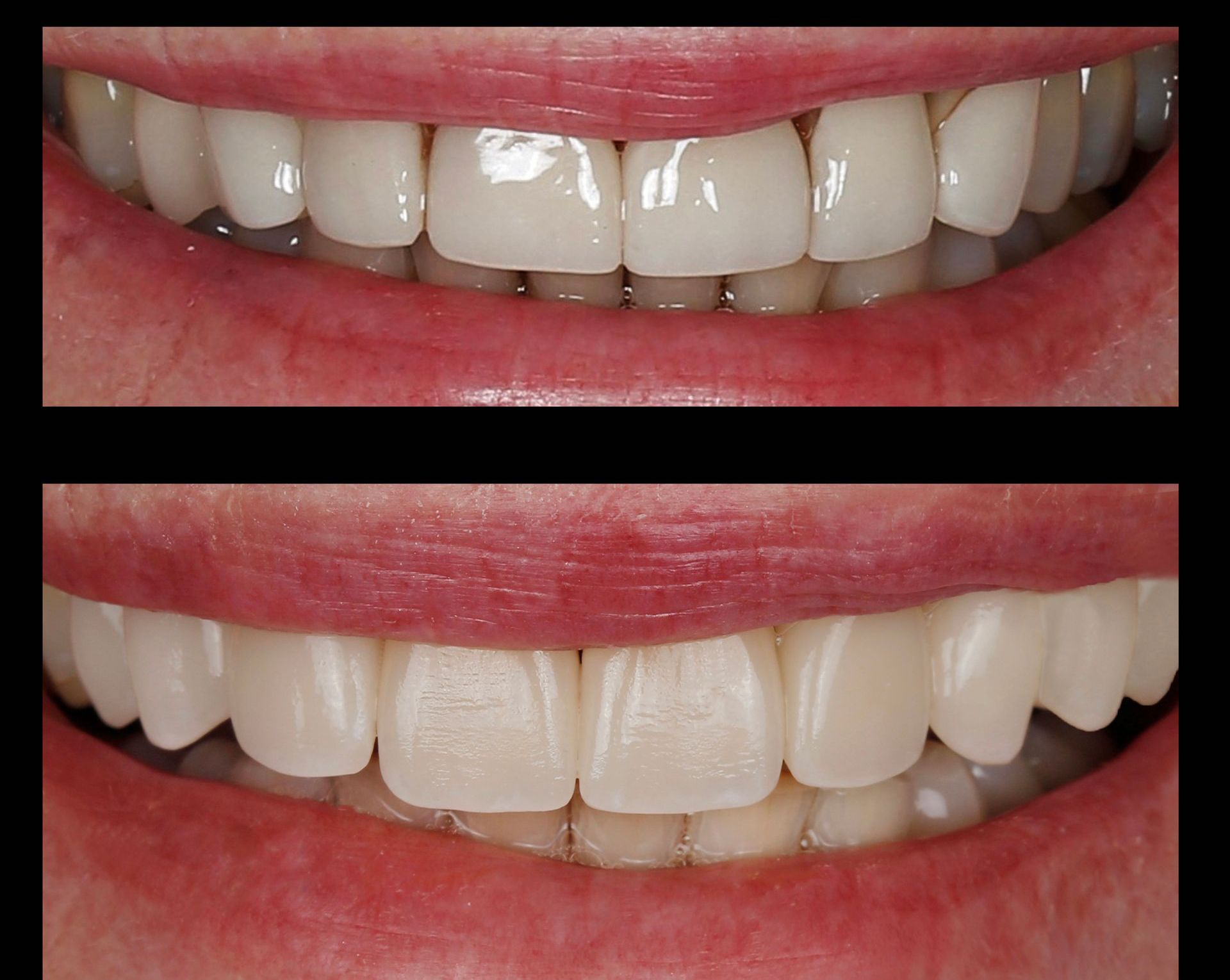Close-up of teeth before and after whitening, showing brighter, more even white teeth.