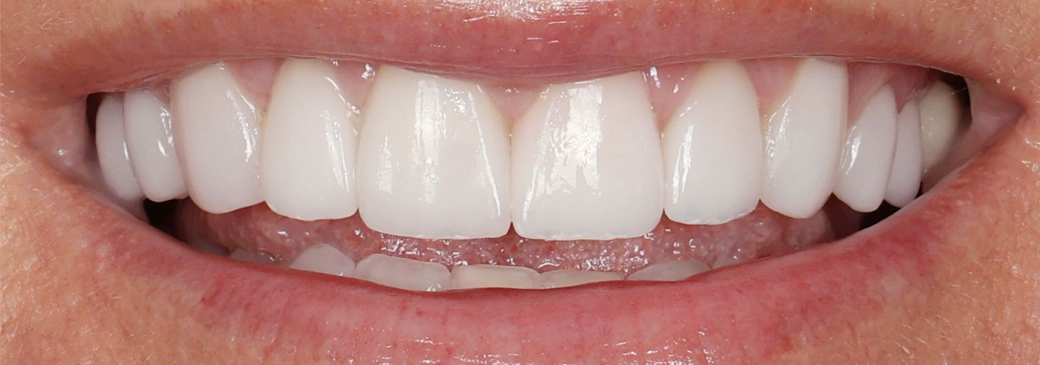 Close-up of a smiling mouth showing bright white teeth and pink lips