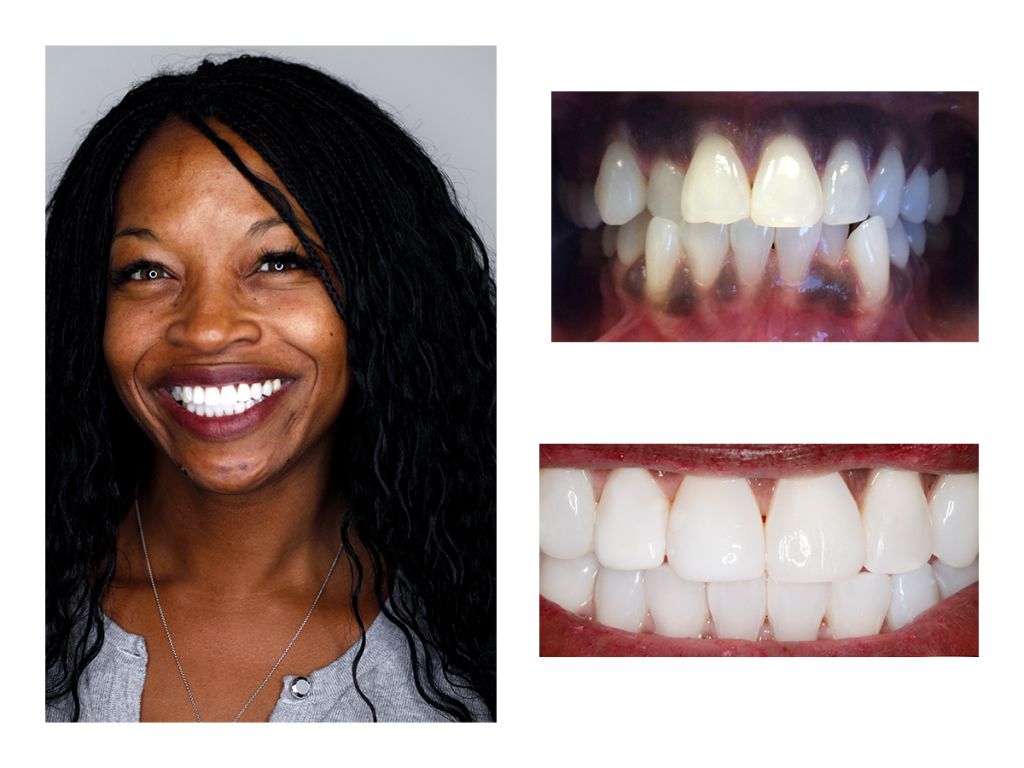 Cosmetic Composite Bonding 24