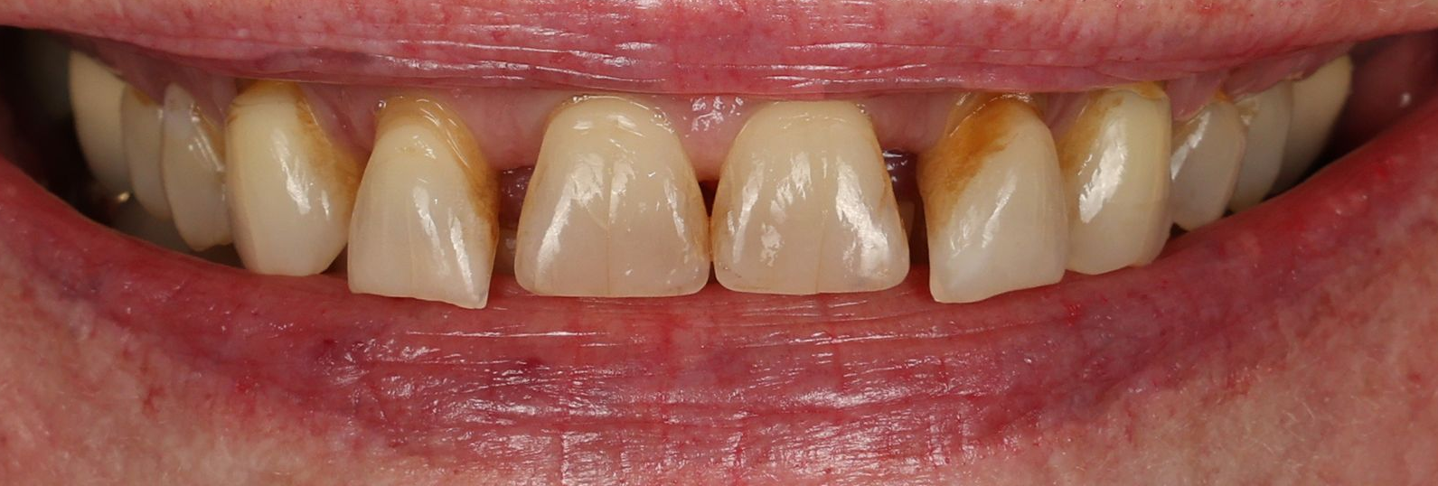Close-up of teeth with yellowed, uneven discoloration and gaps between the front teeth