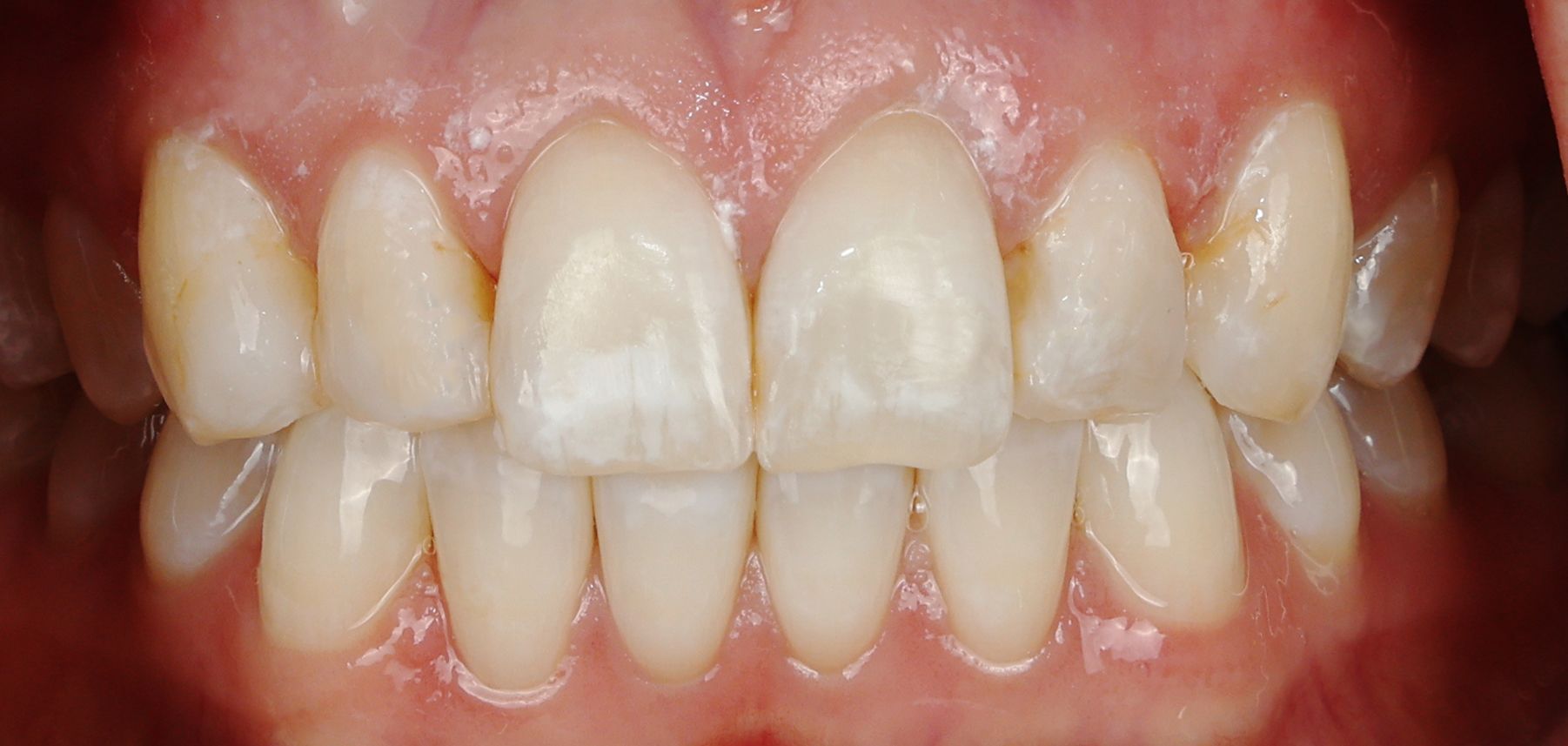 before photo of fluorosis spots on teeth