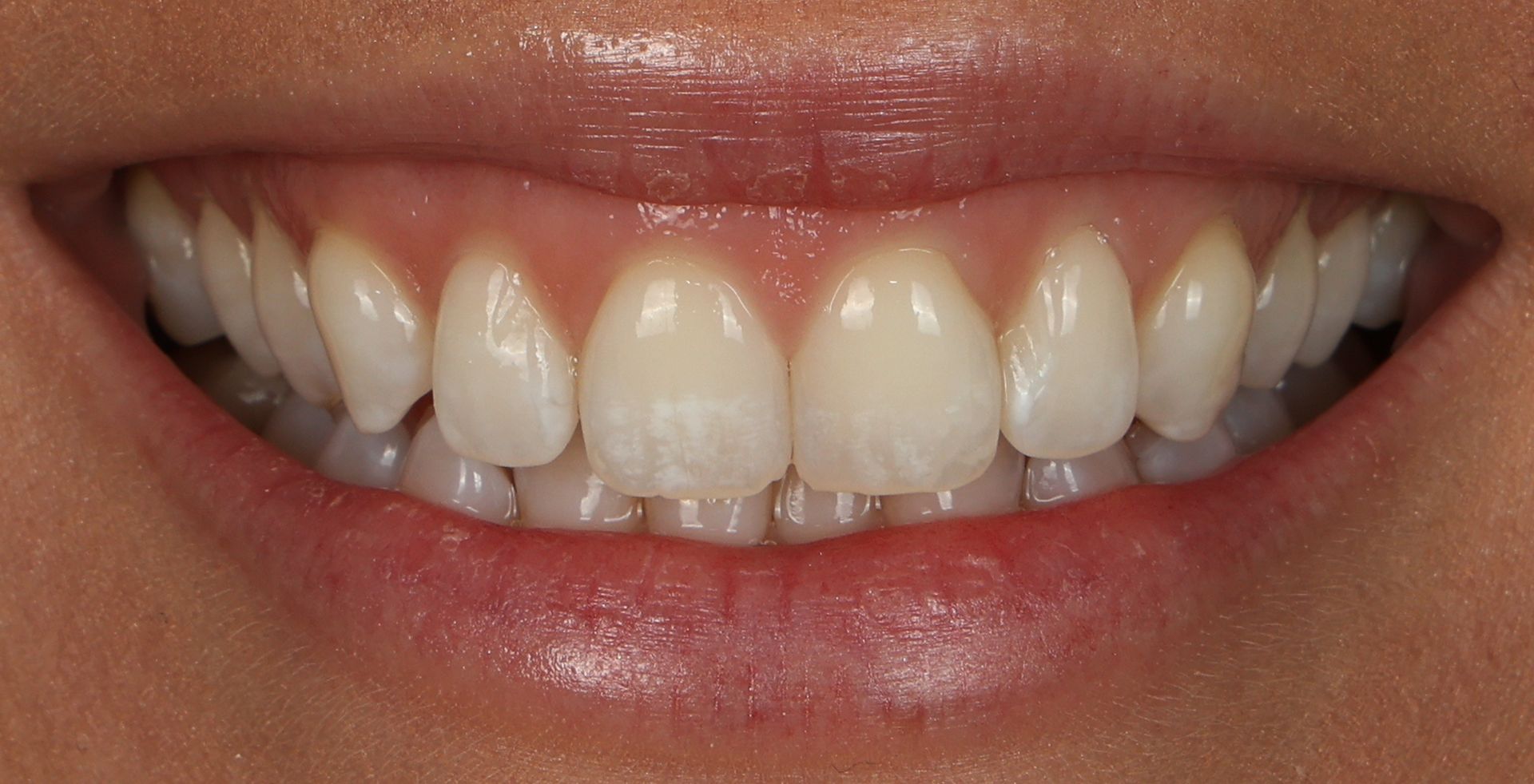 White spots and dark teeth