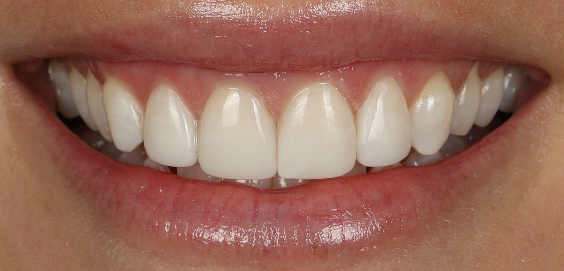 Composite Bonding to create white smile and cover stained teeth