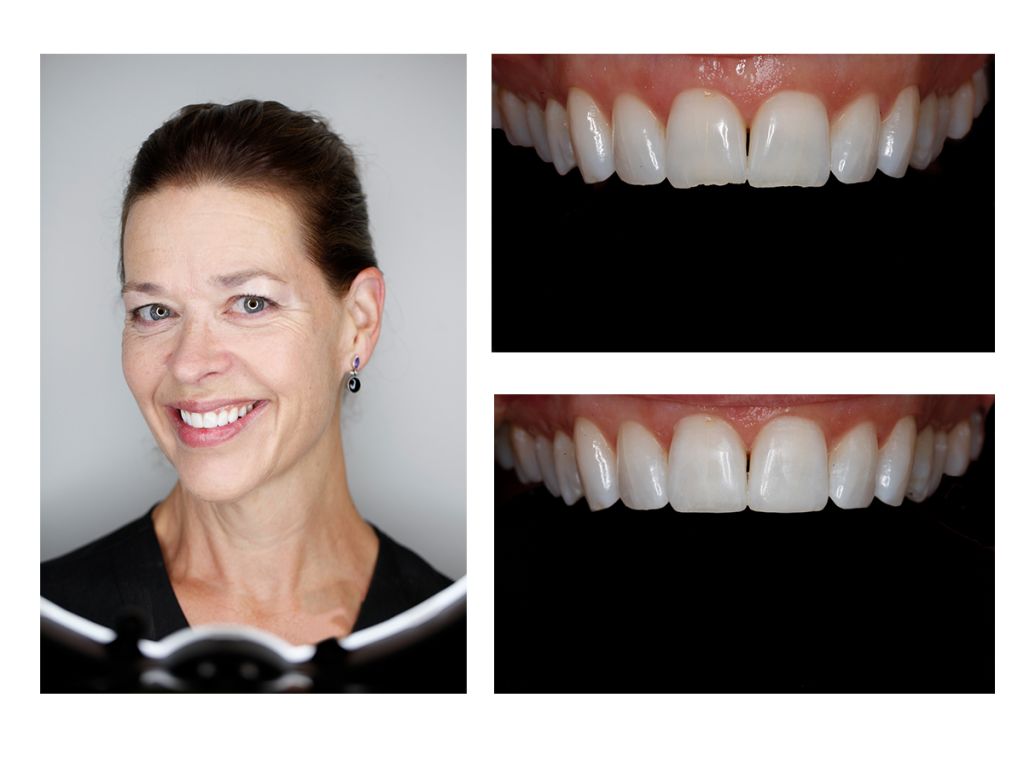 Cosmetic Composite Bonding 26