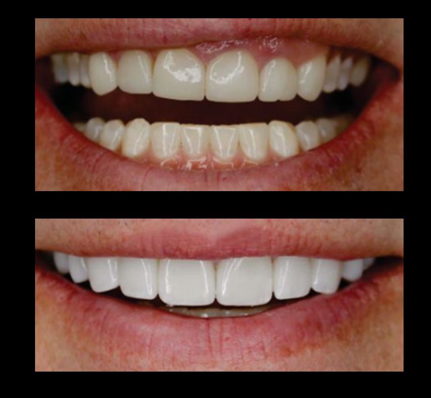 Before-and-after close-up of teeth whitening, showing stained teeth above and brighter white teeth below