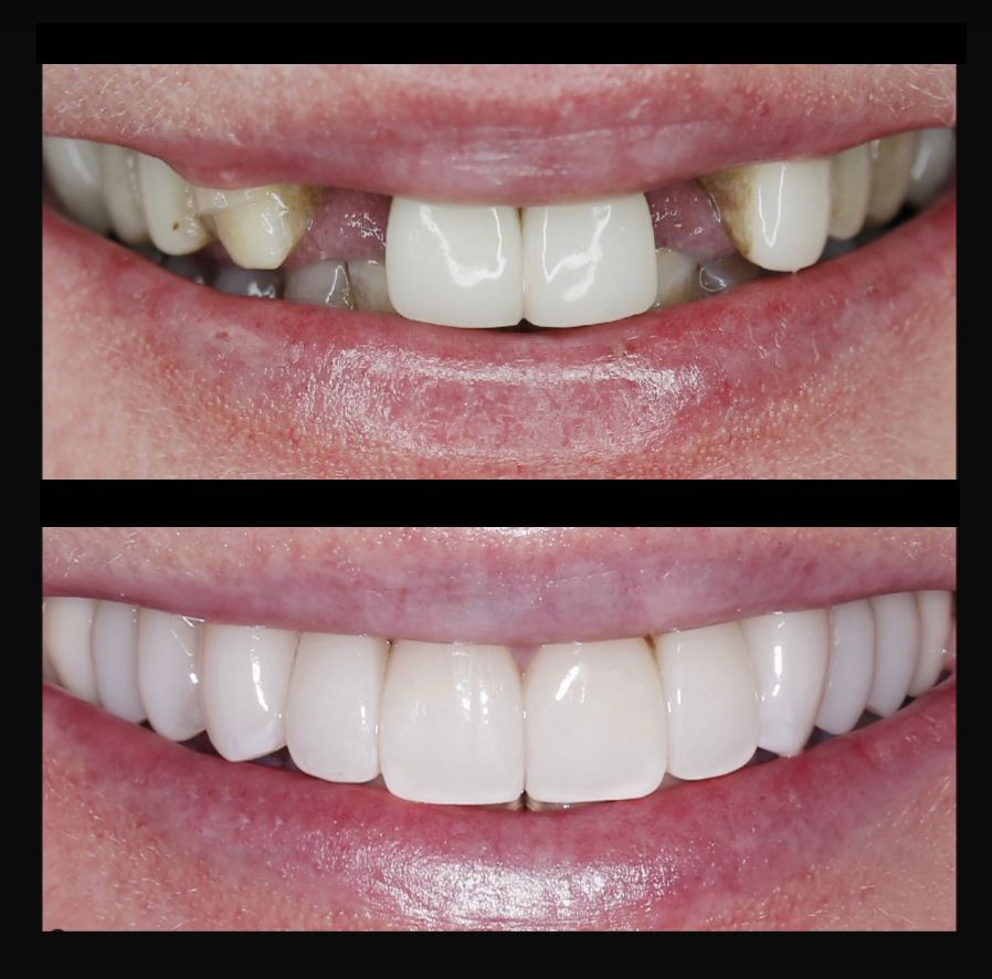 Before-and-after smile showing stained, gapped teeth replaced with bright, aligned veneers.