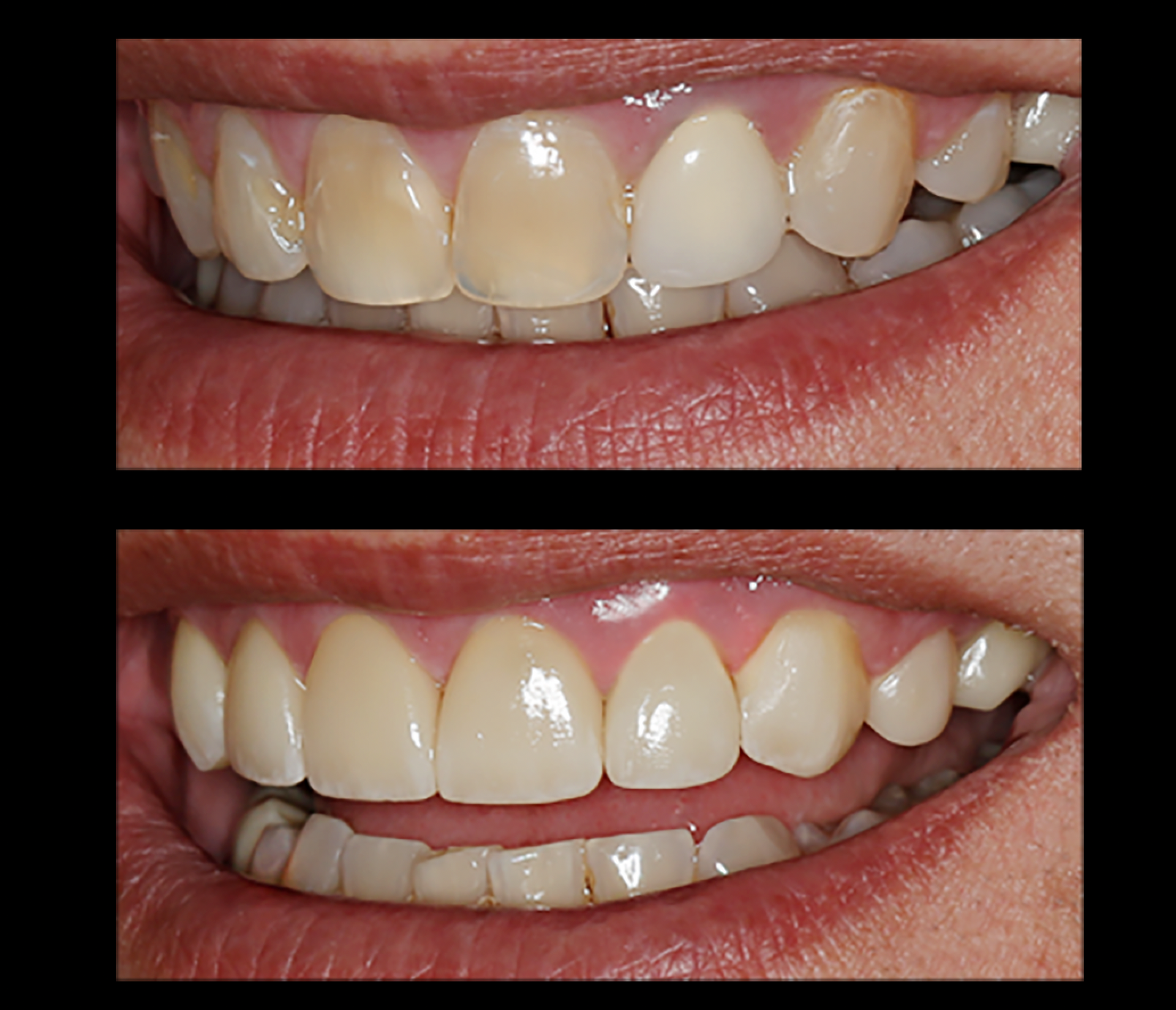 Before-and-after close-up of teeth whitening, showing brighter, whiter teeth in the lower image.