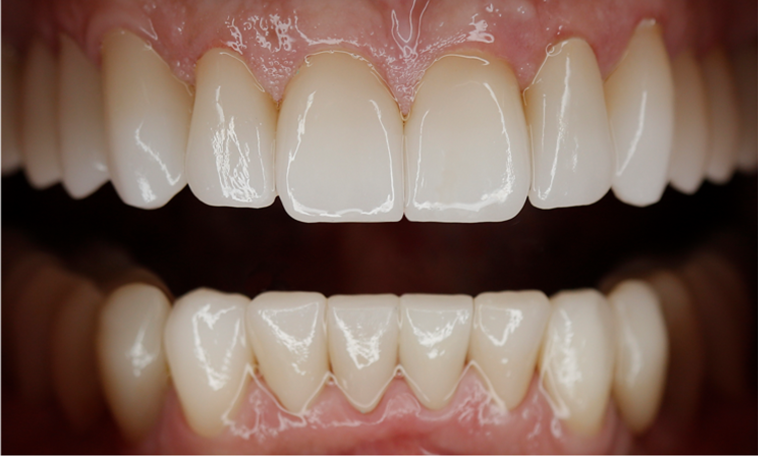 full mouth rehabilitation to restore  aged, worn and broken teeth in denver tech center