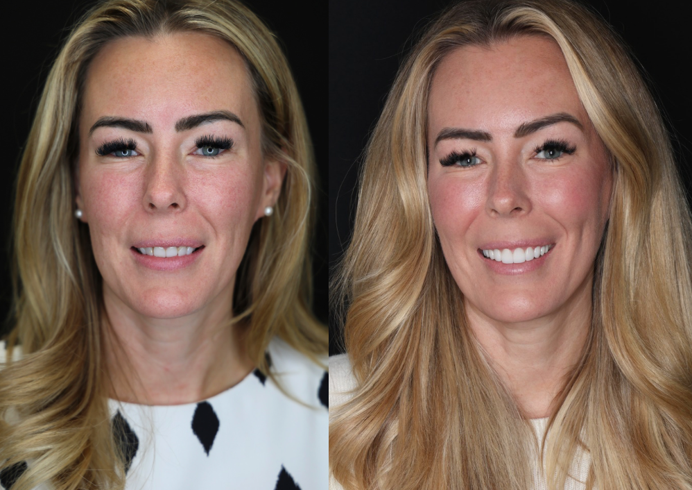 Side-by-side portrait of the same woman, one with a neutral expression and one smiling.