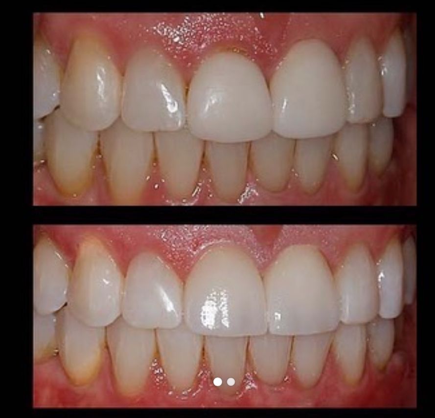 Two close-up photos of teeth and gums, showing a brighter smile on top and bottom comparisons