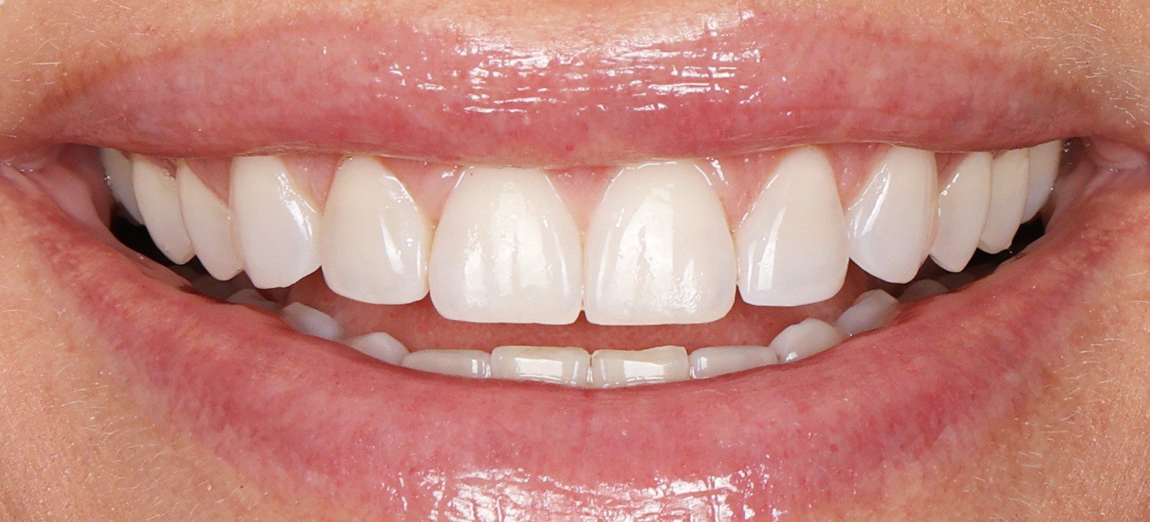 A close up of a woman 's smile with white teeth.