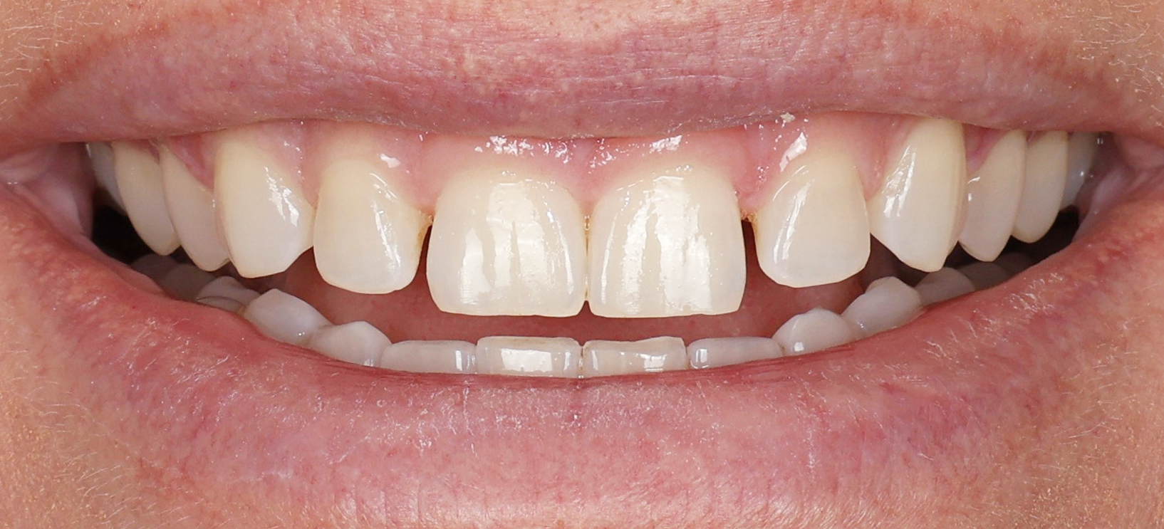 A close up of a person 's teeth with braces.