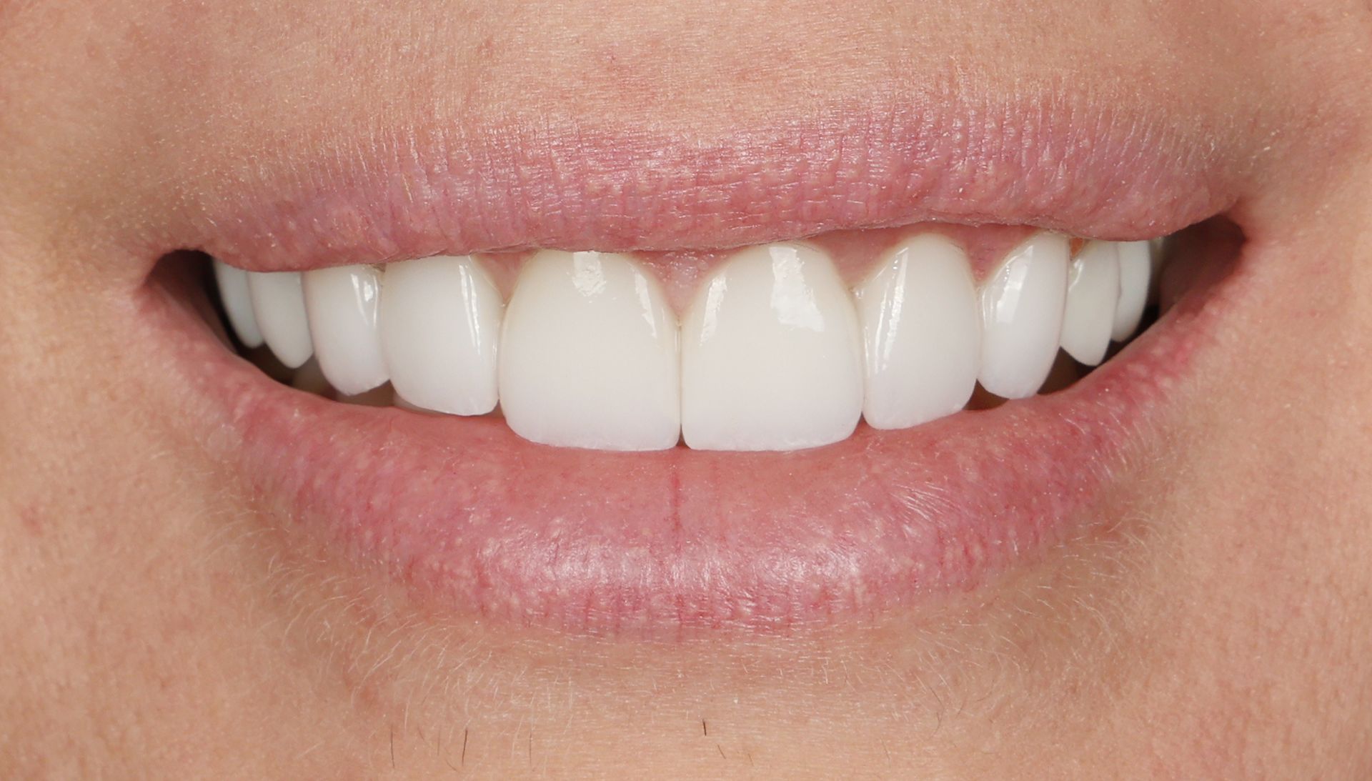 A woman with Porcelain restorations to create a stong white smile that is long lasting