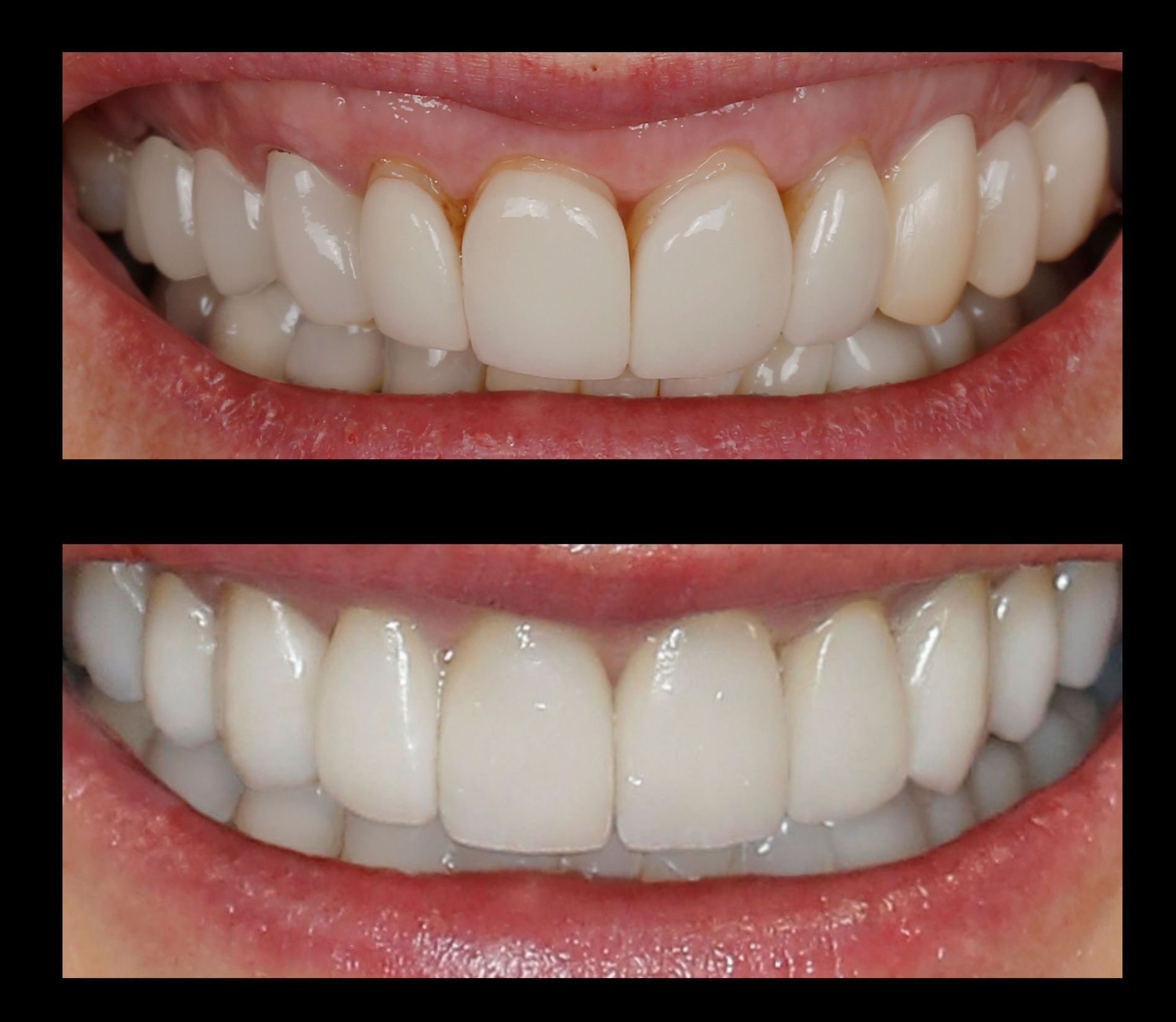 Before and after close-up of teeth, showing a brighter, whiter smile in the lower image.