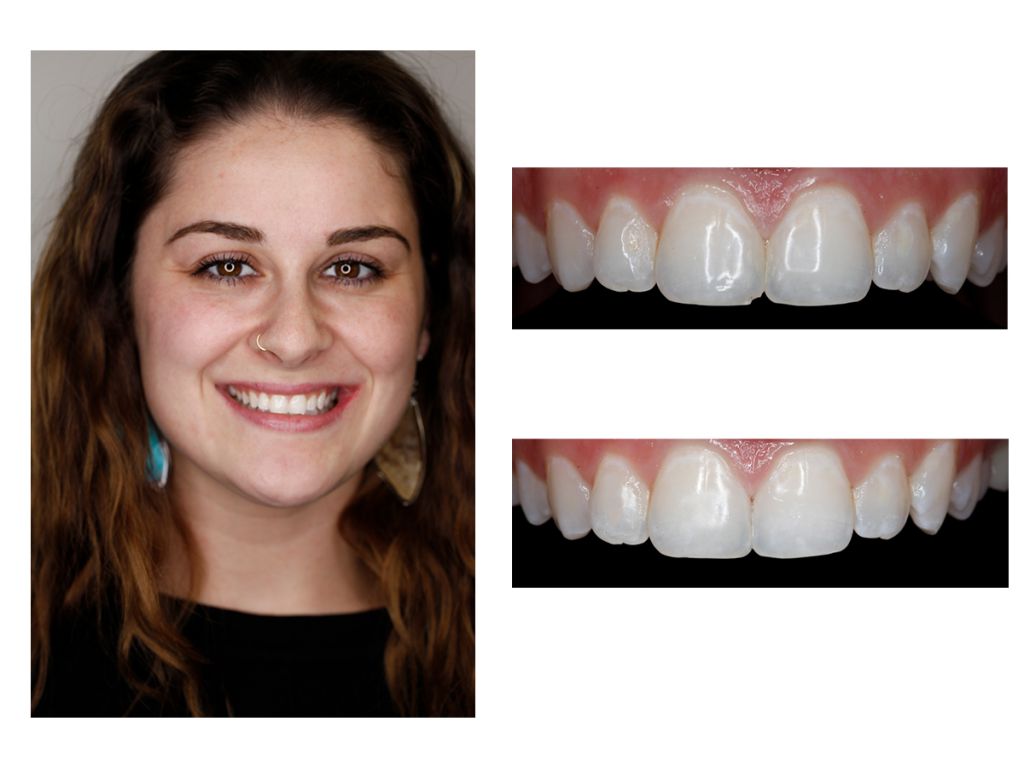 Cosmetic Composite Bonding 25
