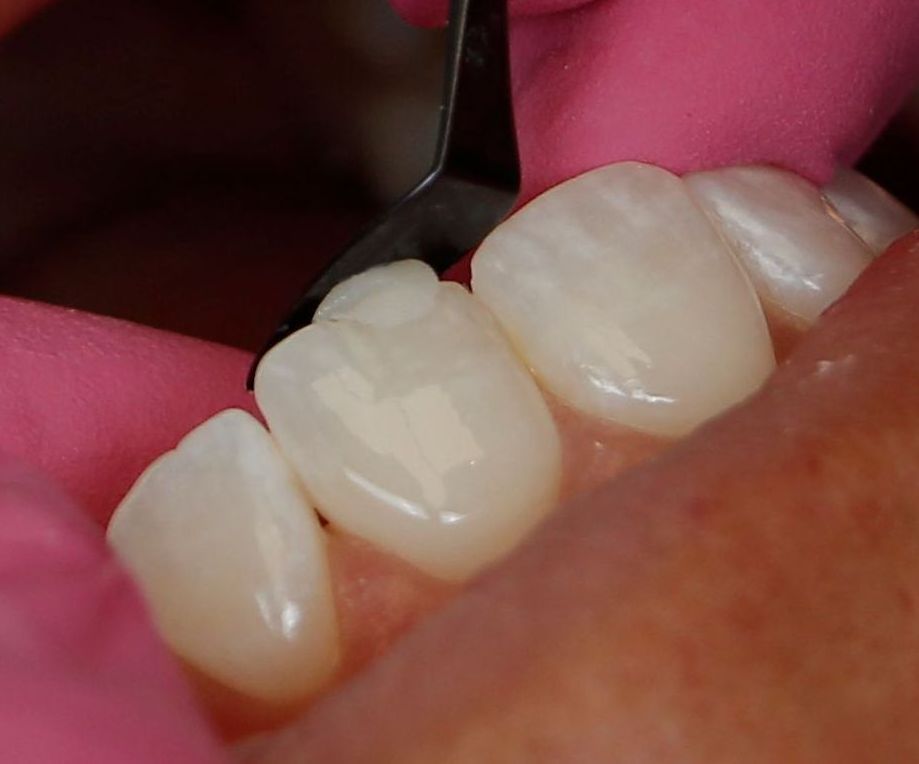 Close-up of white dental teeth being examined with a black tool against pink gums.