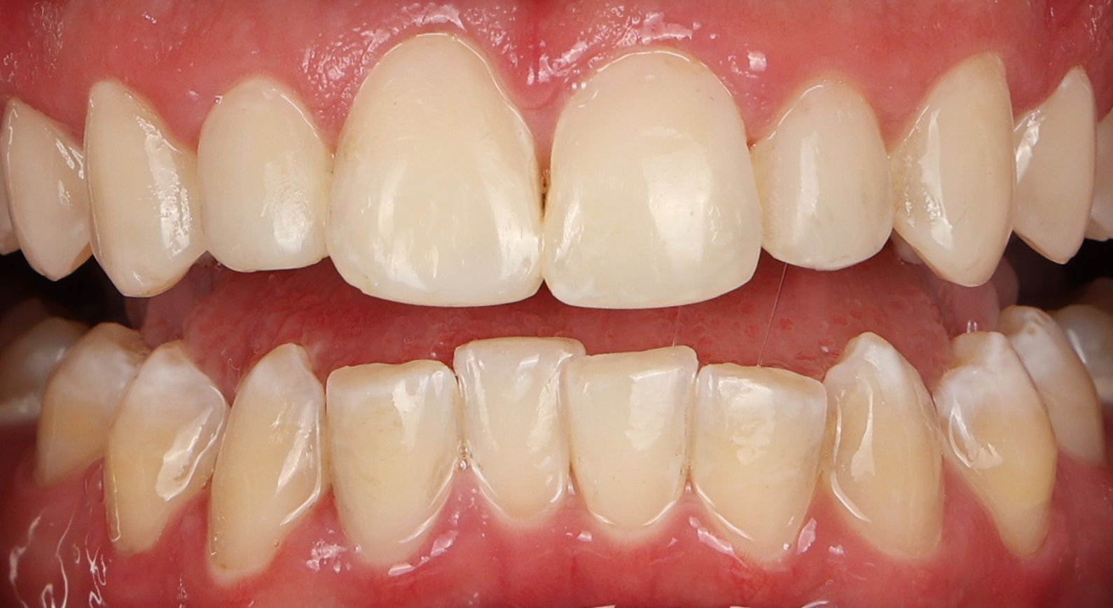 Composite bonding for a healthy white smile