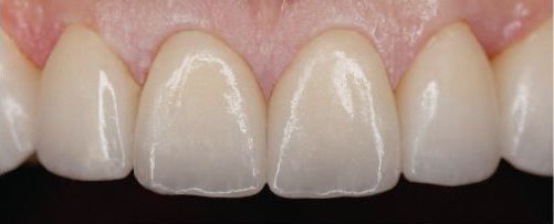Close-up of four white front teeth with pink gums and a natural smile