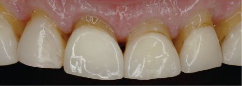Close-up of four front teeth with slightly uneven alignment and pink gums above