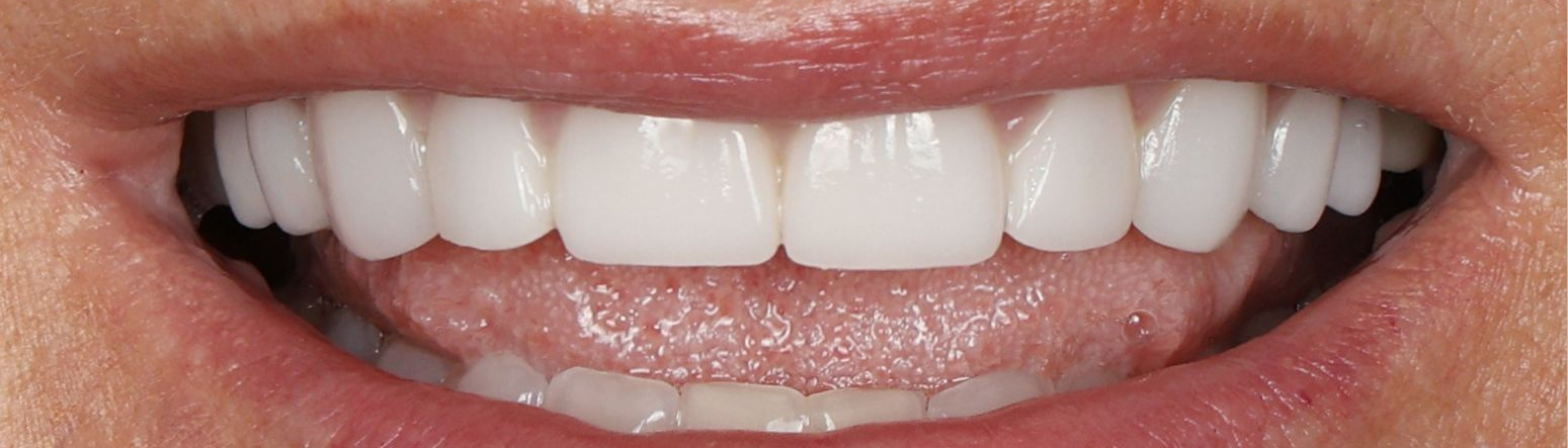 Close-up of a smiling mouth with white teeth and light pink lips