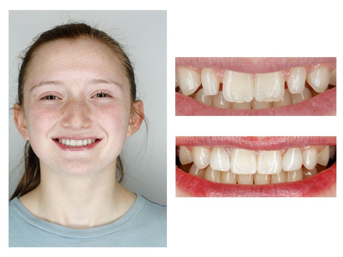 Cosmetic Composite Bonding 3