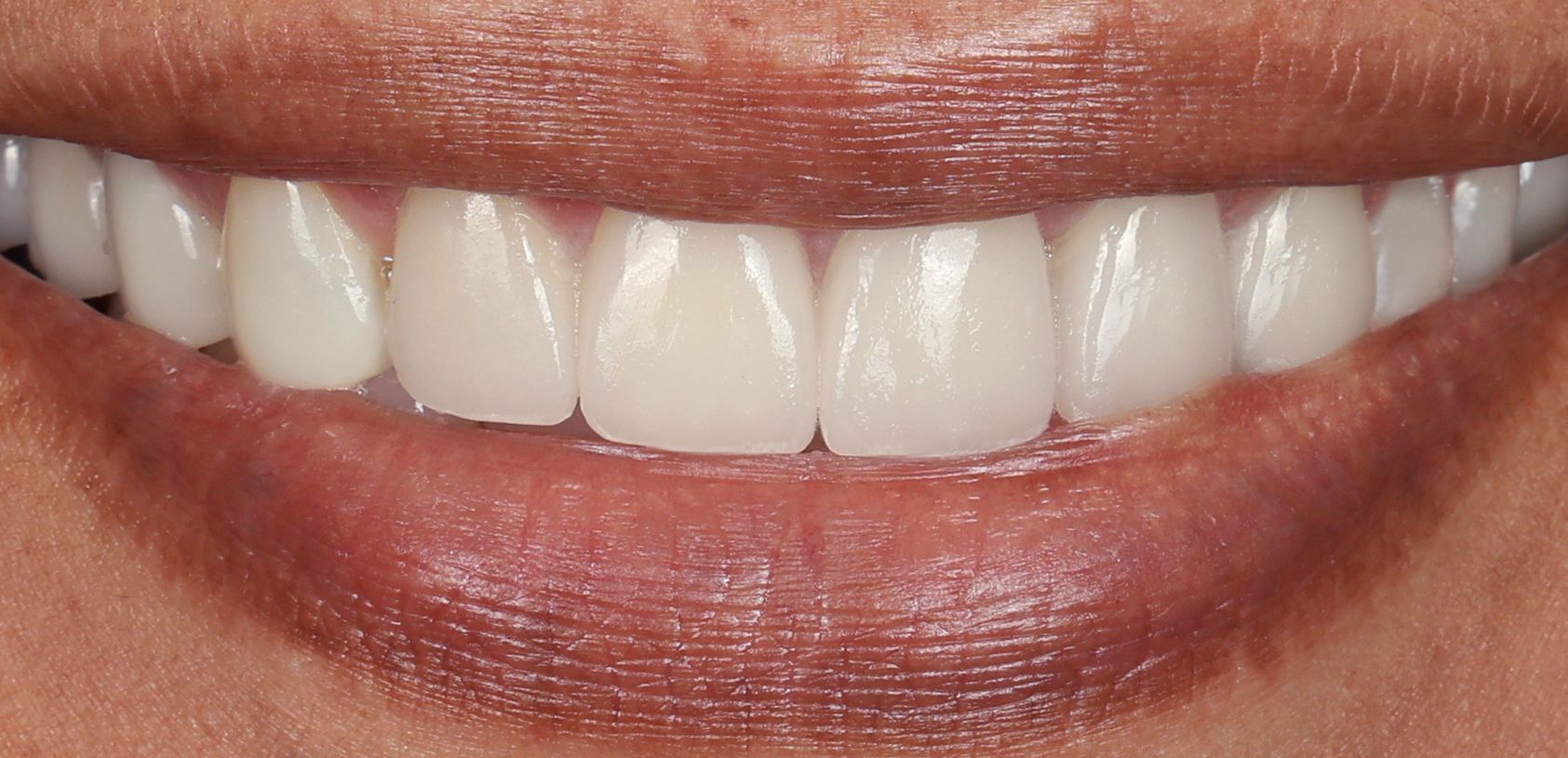 Close-up of a smiling mouth with white teeth and glossy lips