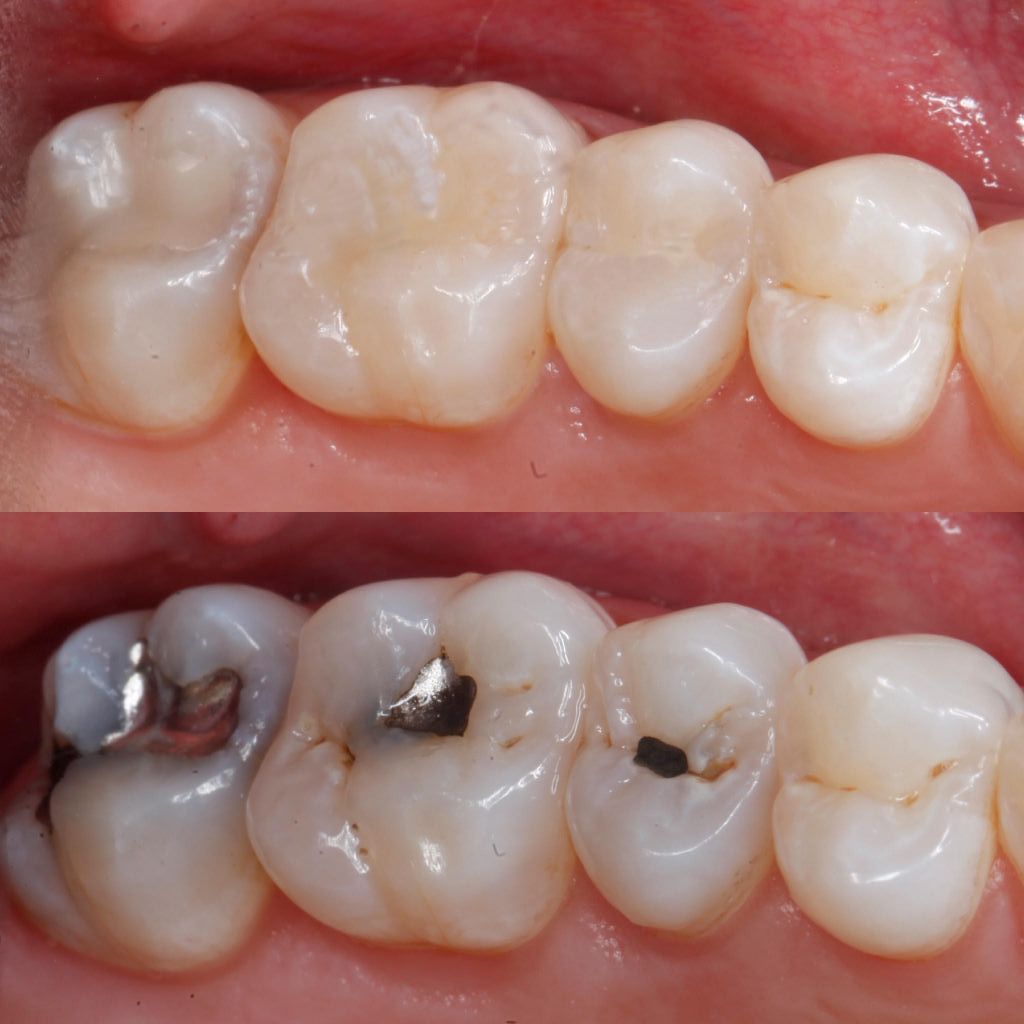 A before and after picture of  changing silver fillings