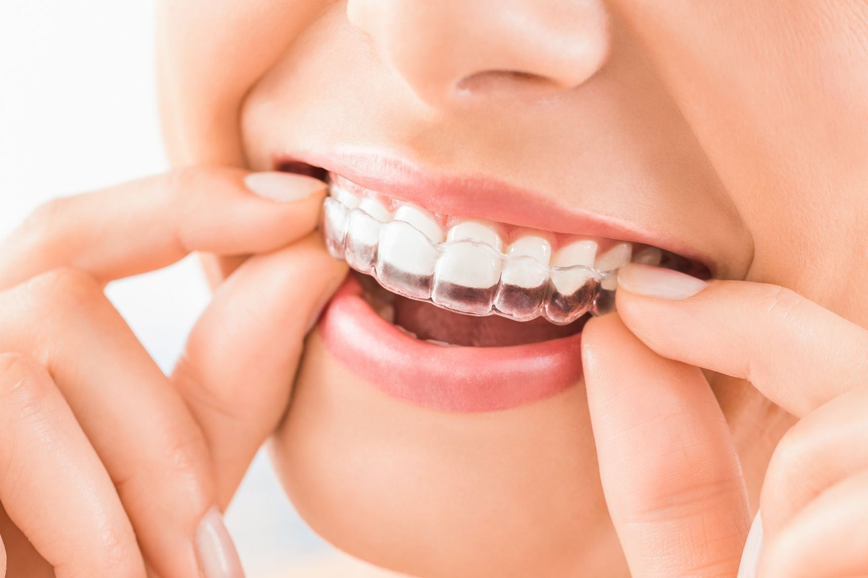 WHAT IS INVISALIGN® & HOW DOES IT WORK?