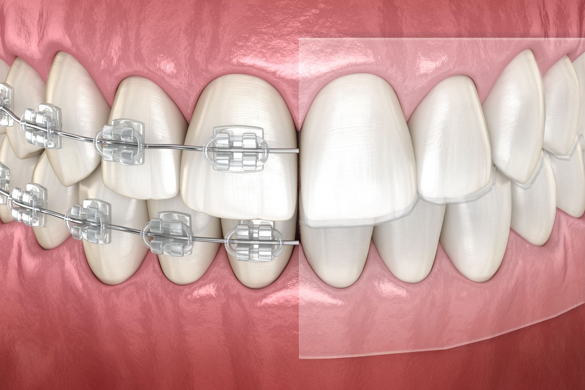 INVISALIGN® VS. BRACES: WHAT'S THE DIFFERENCE