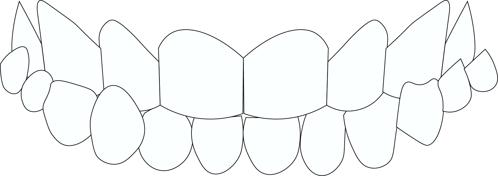 crossbite