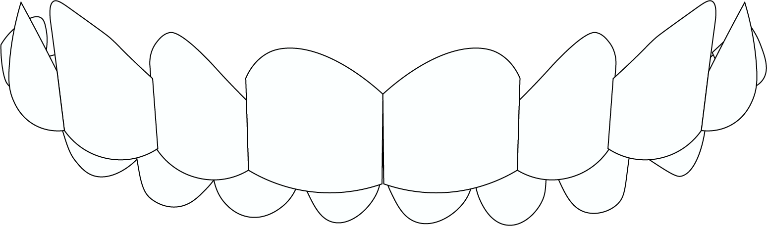 overbite