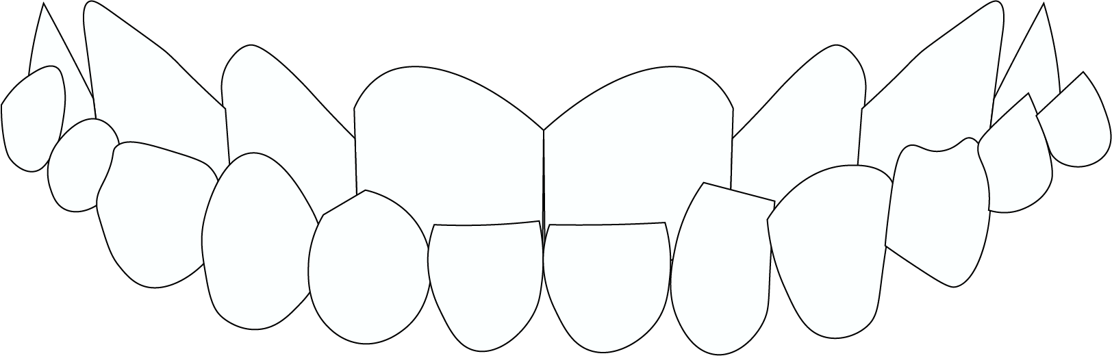 underbite