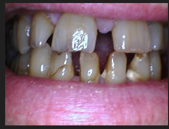 invisalign before image