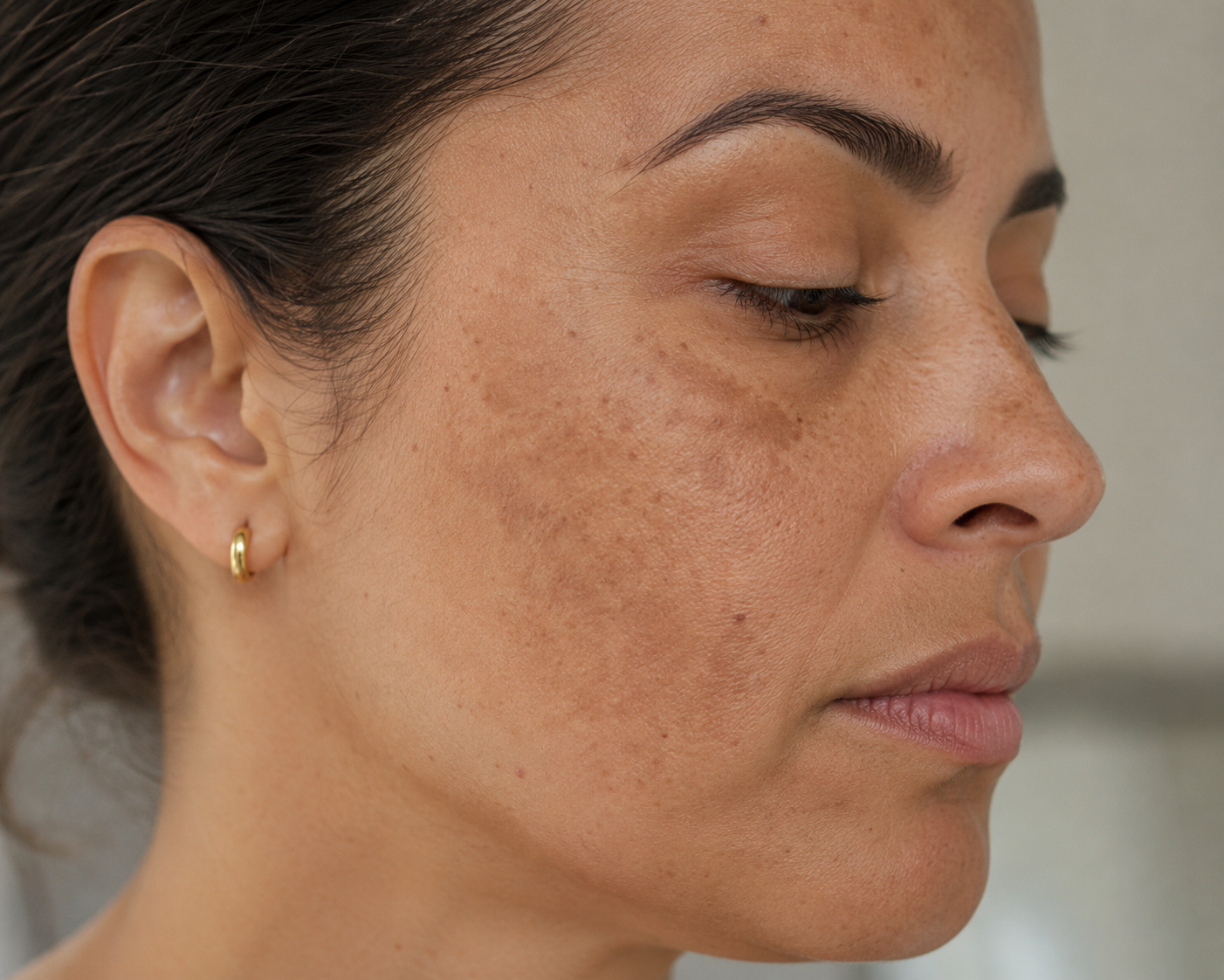 Paciente com melasma facial realizando avaliação dermatológica para tratamento e controle das mancha