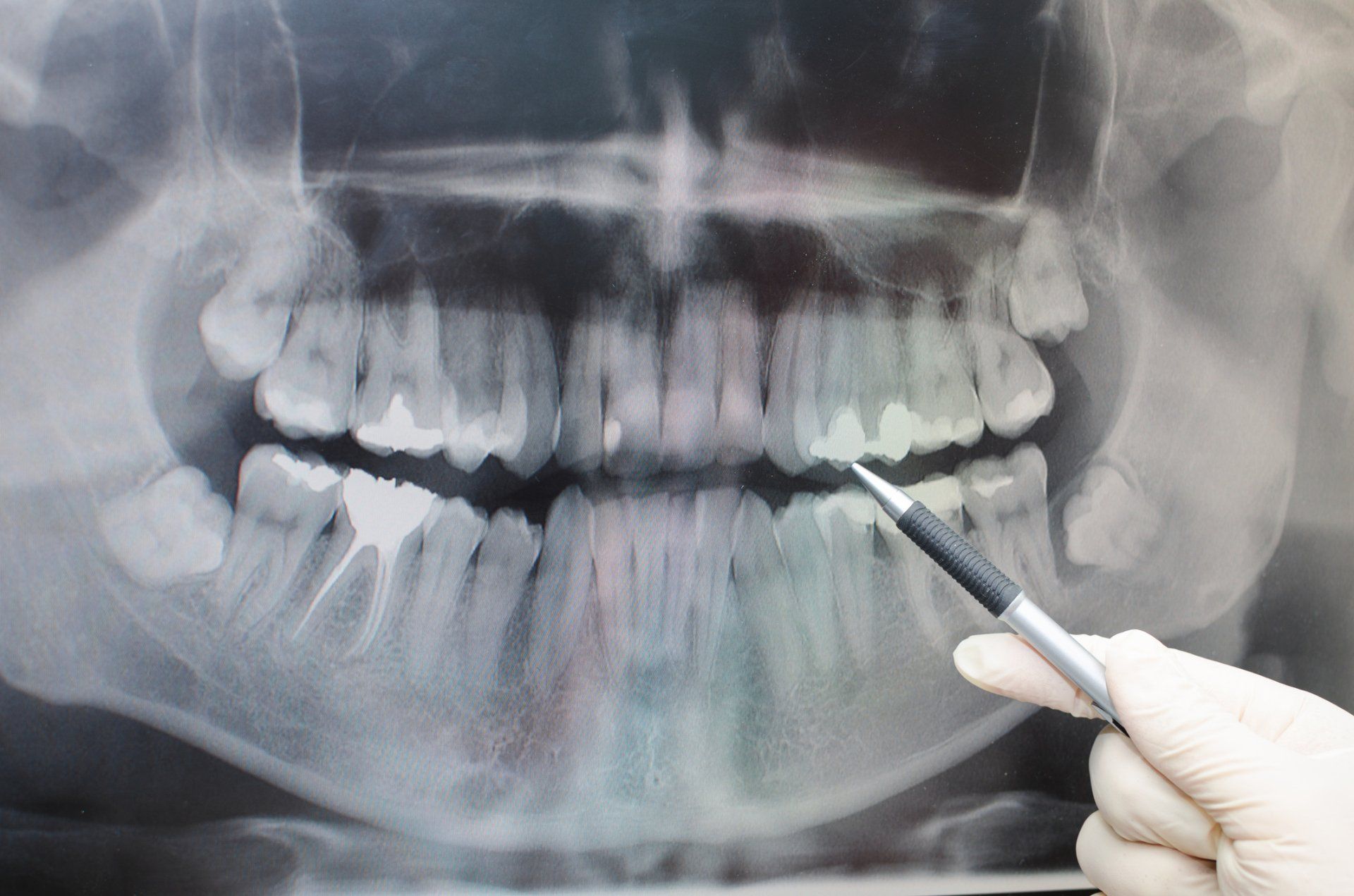 Dental xray — Wytheville, VA — Wilson Dental