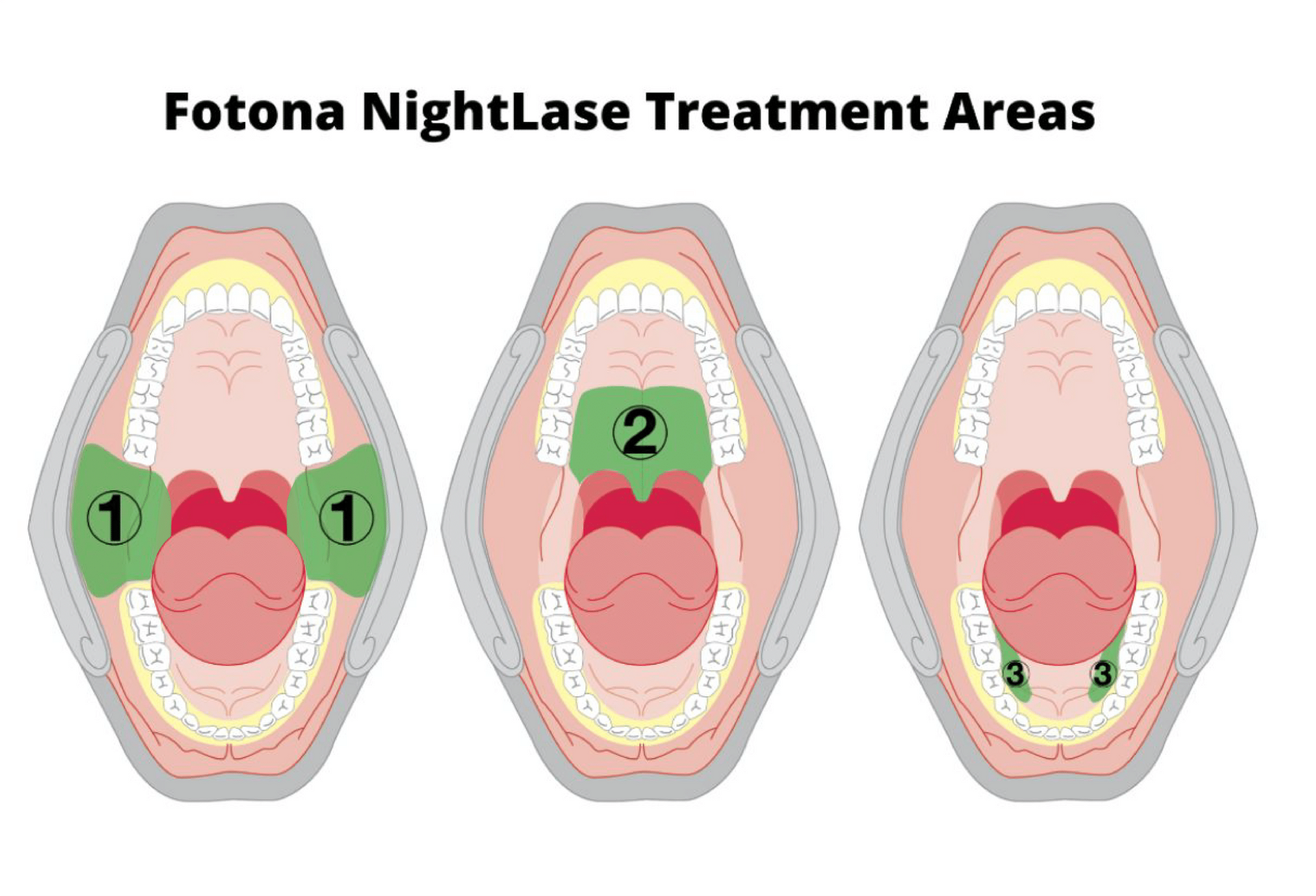 NightLase®: A Simple, Non-Invasive Solution for Snoring
