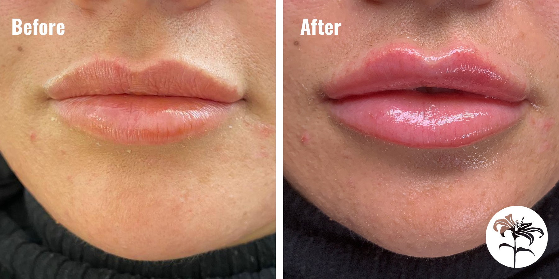 Before and After Lip Filler Treatment Before and After Lip Filler Treatment