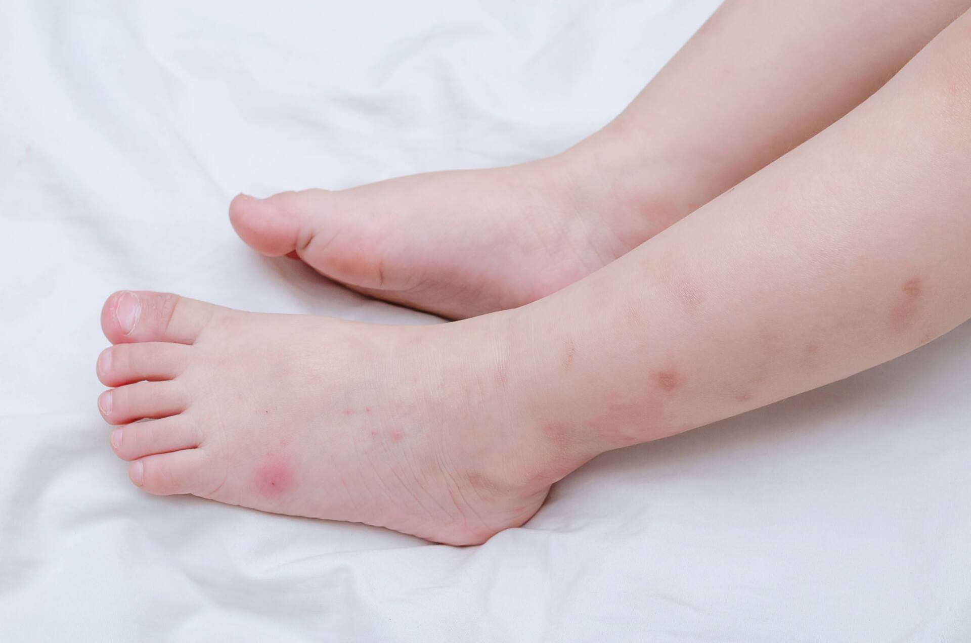 Child's legs and feet resting on a white surface, with several reddish-brown spots visible.