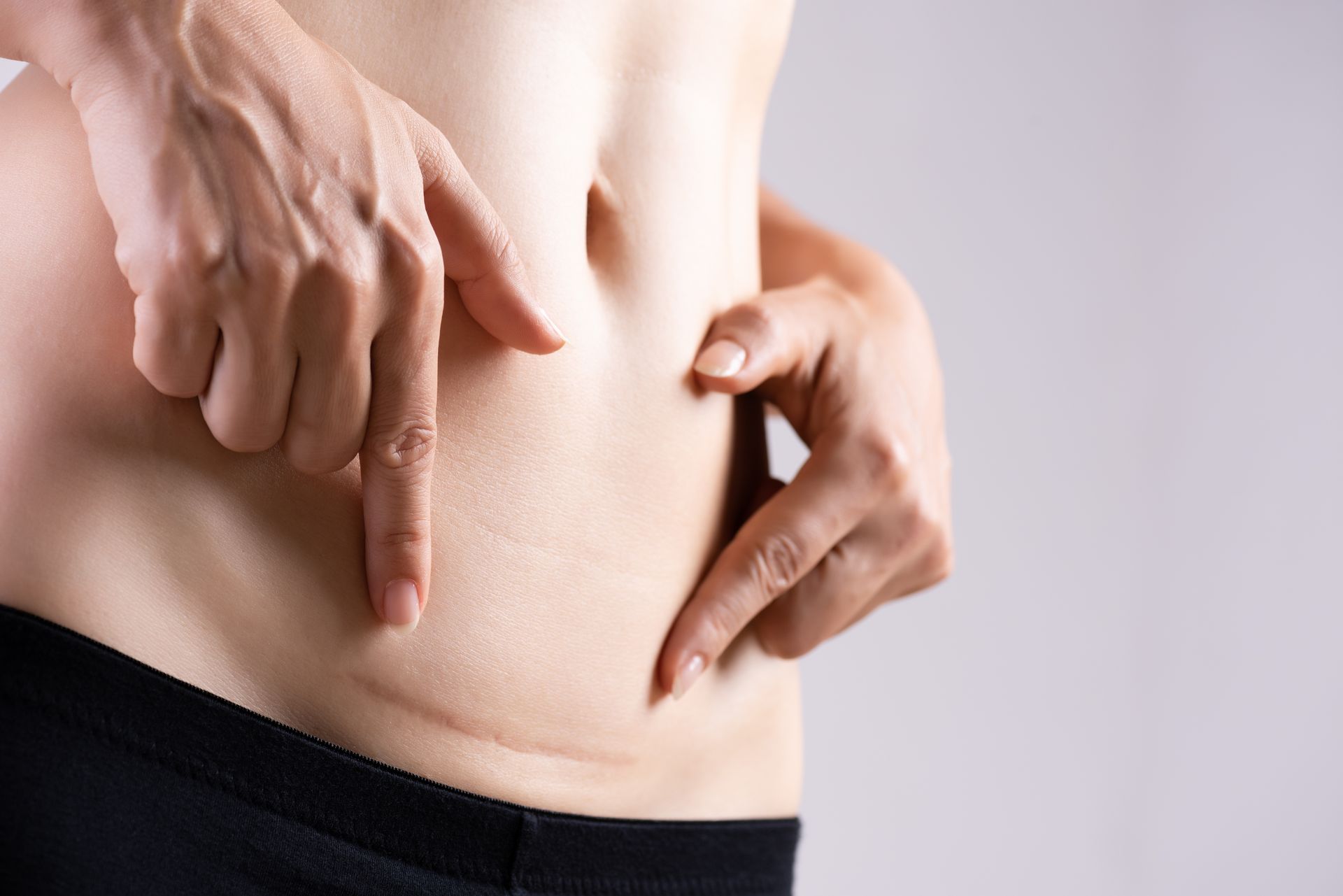 scar treatment san francisco, tummy tuck scar treatment san francisco, tummy tuck hyperpigmentation treatment hyperpigmentation, keloid treatments san francisco ca
