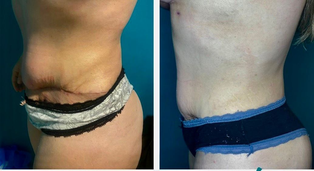 Side-by-side torso views showing the same body with different tan lines from a strap or waistband.